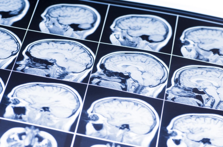 Understanding the Long-Term Impact of a Traumatic Brain Injury
